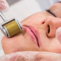 Cây lăn kim da mặt tiện dụng, cải thiện làn da